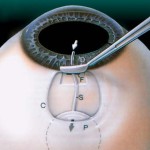 Cirugia-de-Glaucoma