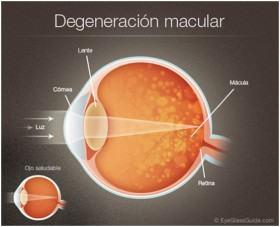 degeneracion-macular