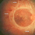 retinopatia